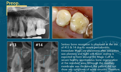 After implant treatment