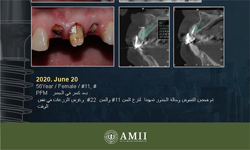 After implant treatment